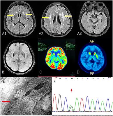 Case Report: Progressive Asymmetric Parkinsonism Secondary to CADASIL Without Dementia